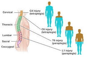 Spinal Cord Injury (SCI)