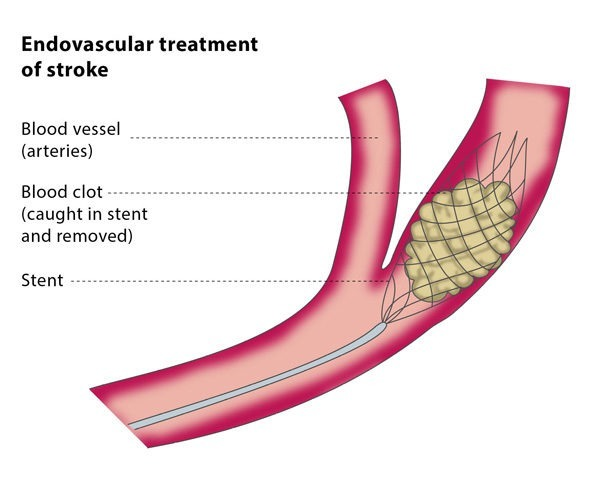 Diagram of endovascular stroke treatment showing a stent in a blood vessel, capturing a clot. Labels indicate vessel, clot, stent.
