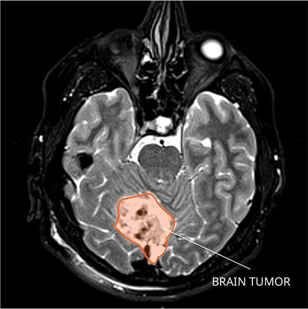 MRI scan shows a highlighted brain tumor in a circle with the label "BRAIN TUMOR." Gray and black tone with visible brain structures.