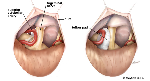 Illustration of brain surgery shows trigeminal nerve, dura, and superior cerebellar artery with labeled teflon pad placement.