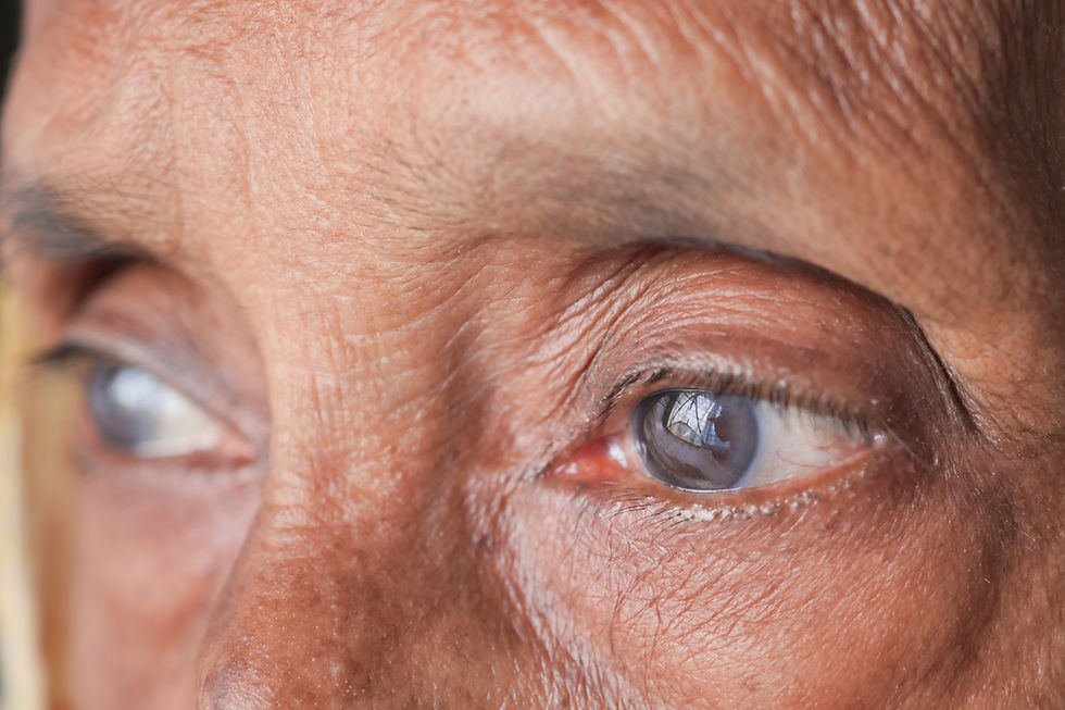 elderly man with cataract