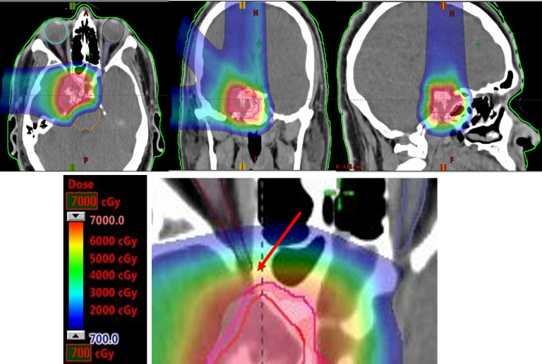 Radiotherapy scan with color gradient from 700-7000 cGy highlighting targeted areas. Red arrow points to a high-dose region.