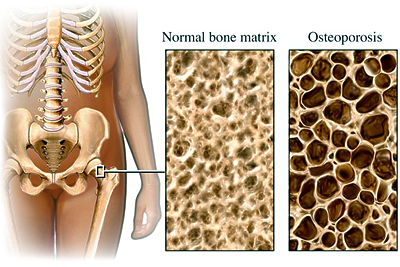 Illustration of a human skeleton's hip, comparing normal bone matrix and osteoporosis. The two bone textures are side by side.