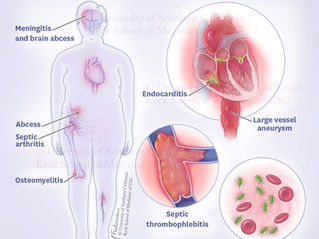 Digital illustration showing the clinical syndromes seen in non-typhoidal salmonella. On the left side, we see a patient with ghosted in brain, hip joint, femur and lower leg vein. On the right are circles containing an illustration of the heart showing endocarditis and large vessel aneurysm. A blue vein with a blockage, septic thromboembolism and bacteremia, bacteria in the bloodstream.