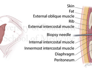 Illustration of male figure reclining with right arm raised over head. Liver can be seen ghosted in on figure and is being biopsied with large needle. A cross section view of the layers of the body and liver are shown on right side of page being biopsied with needle.