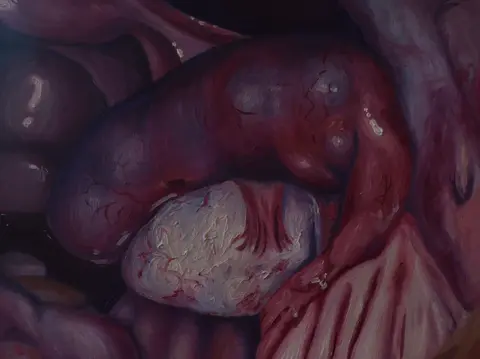 ectopic.