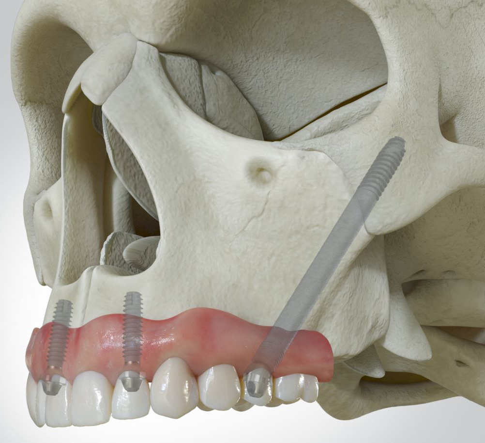 Blue Sky Bio implant range from 6mm through zygomatic solutions