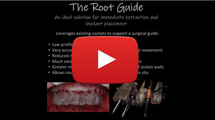 Root Guide workflow concept and clinical advantages explained in BlueSkyPlan guided surgery training video
