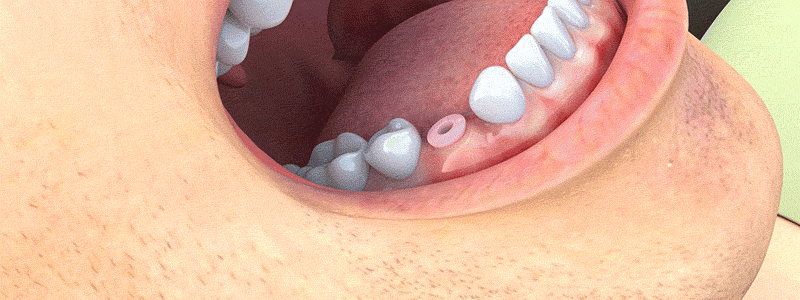 healing-abutment-2.gif