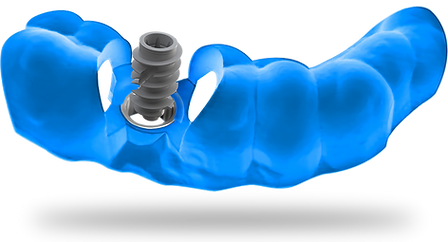 surgical-guide-with-dental-implant.png