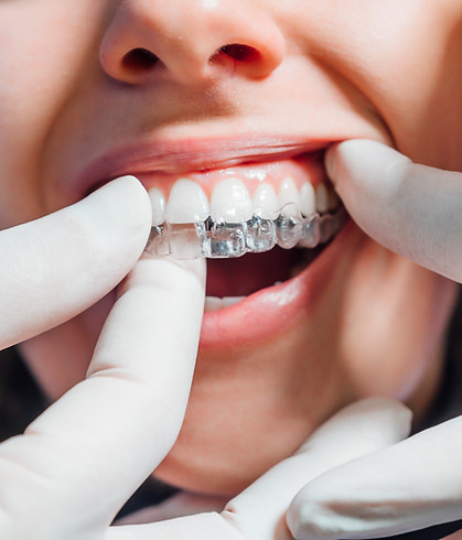 doctor-putting-clear-dental-aligner-pati