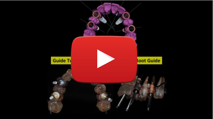 Root Guide workflow step-by-step BlueSkyPlan software tutorial demonstrating guided implant planning technique