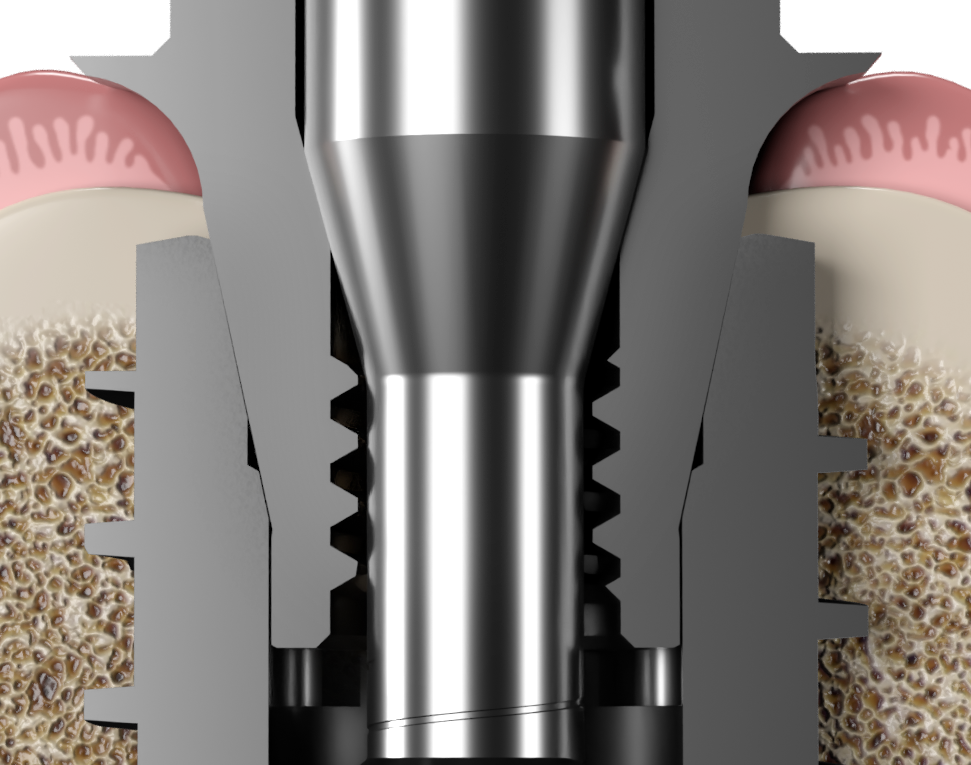 BIO Max 12-degree conical implant connection