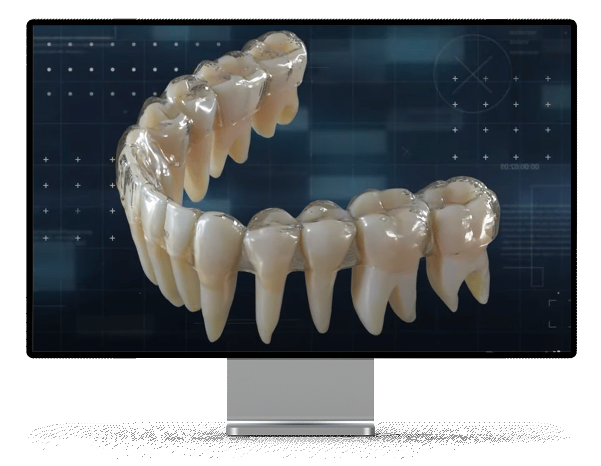 Image of pronto aligners in monitor