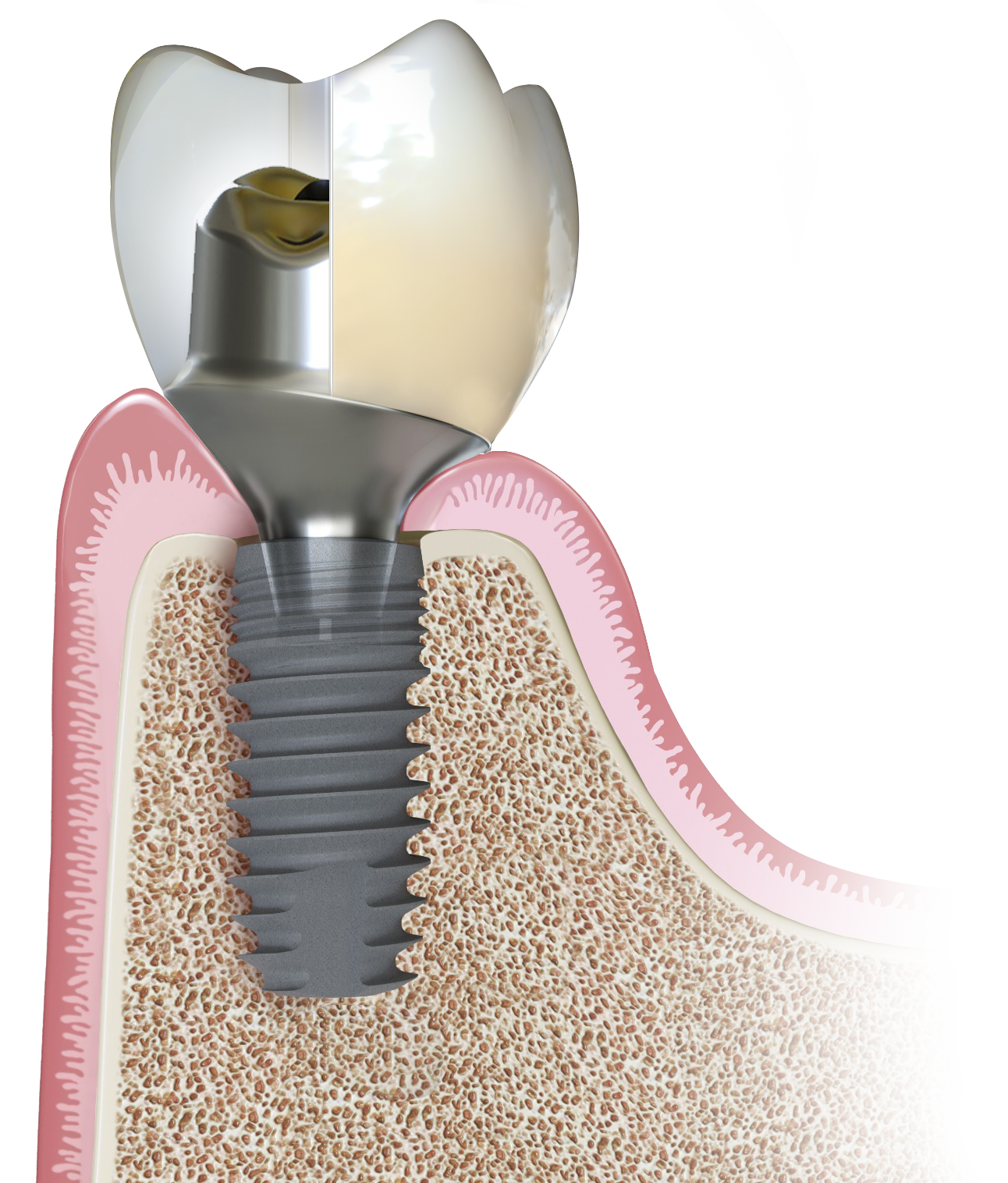 Fracture-Proof custom abutment, zirconia crown, and implant cross-section