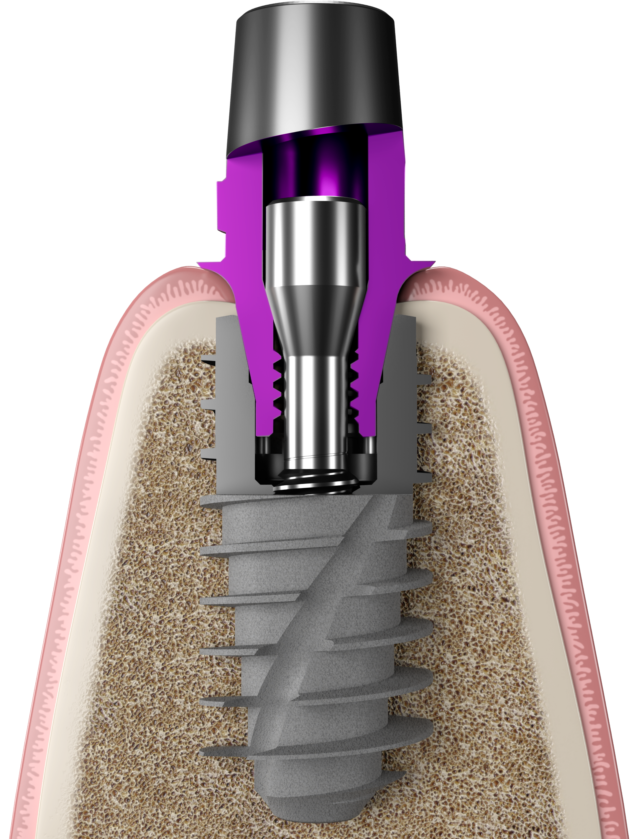 BIO Max complete implant family with one restorative connection