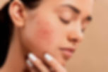 best-acne-treatment-in-mumbai-at-affordable-price-cost-india-2.jpg