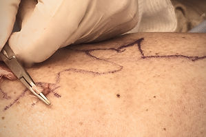 Micro Phlebectomy
