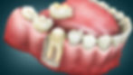 Illustration of a dental crown placement on a molar. The cutaway view shows roots inside gums, with a pink tongue and white teeth visible.