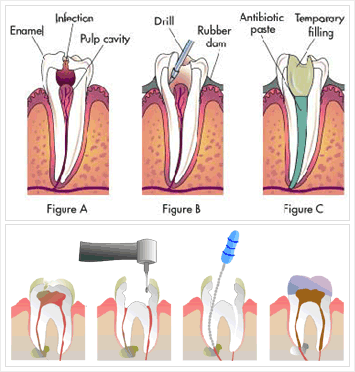 root-canal-treatment-500x500.gif