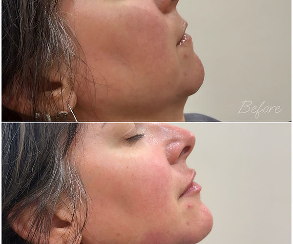 Patient with chin and lip filler