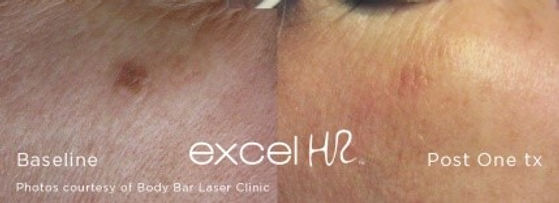 Excelhr treatment.jpg