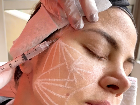 hidratación facial inyectable ácido hialurónico - Dra. Juliana Castellanos Cali