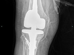 Revizyon Diz Protezi Hakkında Merak Edilenler