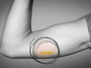 My Experience with Nexplanon (Birth Control Implant)