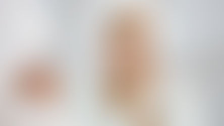 Manchas na pele de melasma tem cura? O que melhora e o que piora as marcas