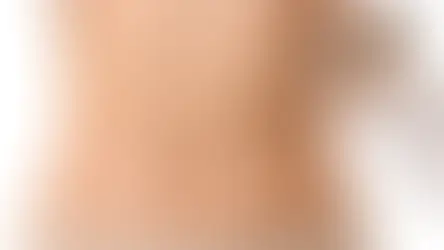 HIDROLIPOCLASIA NÃO ASPIRATIVA