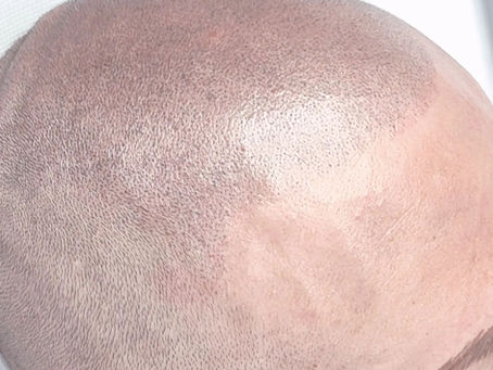 Tricopigmentazione effetto rasato eseguita da Rosanna Dell'Olio