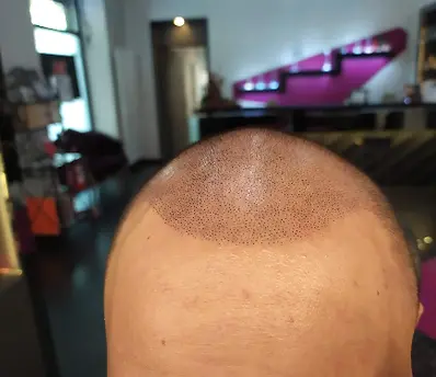 Spledido trattamento di tricopigmentazione effetto rasato