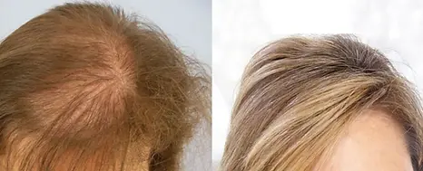 impianto di biofibre biocompatibili su una donna con capelli biondi