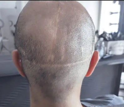 Testa con cicatrici post trapianto di capelli e cicatrici post incidente