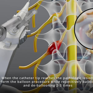 카테터 구조 및 시술 과정 3D 애니메이션 | Catheter Procedure Visualization 프로젝트 소개