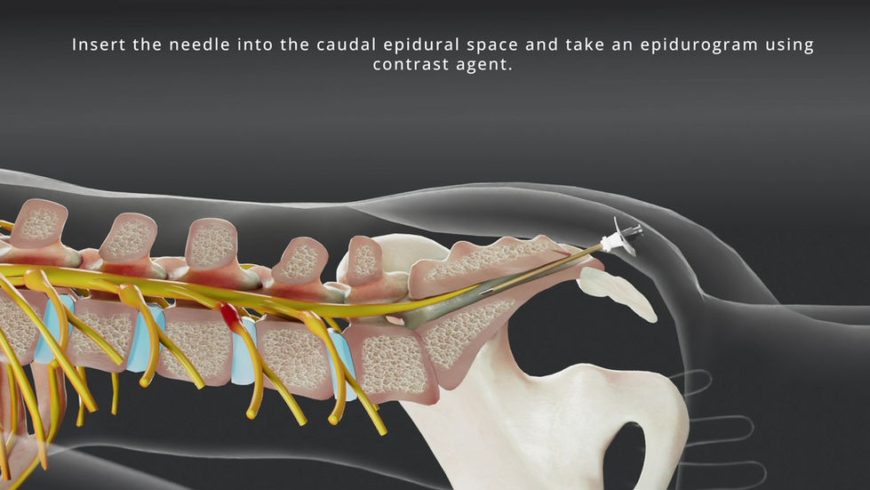 카테터가 경막외 공간을 따라 병변 부위로 진입하는 경로를 표현한 JUVENUI 의료 3D 시각화