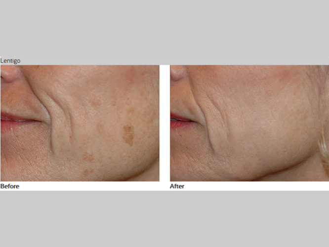 PASTELLE LASER Mirako Spa