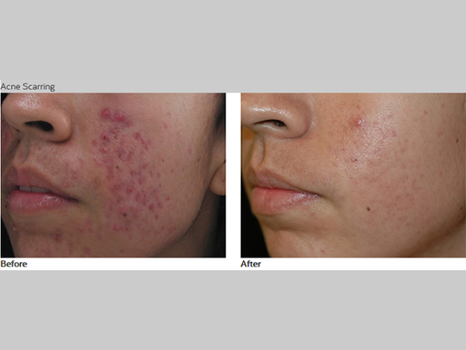 PASTELLE LASER Mirako Spa