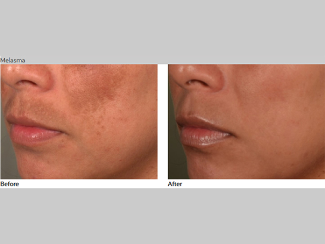 PASTELLE LASER Mirako Spa