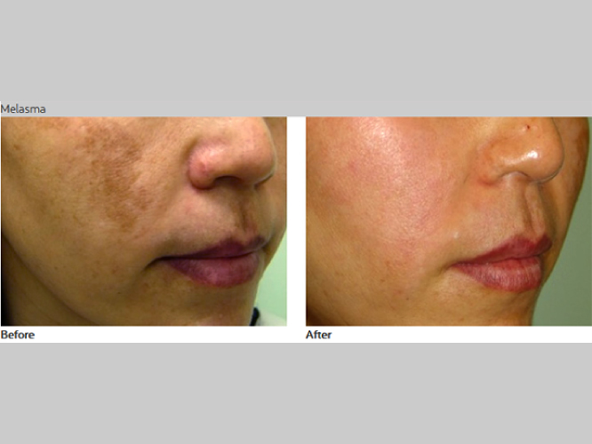 PASTELLE LASER Mirako Spa