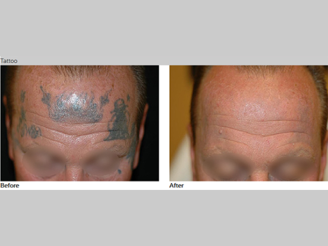 TATOO REMOVAL Mirako Spa