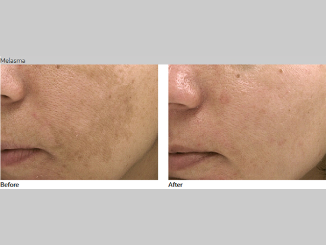 PASTELLE LASER Mirako Spa