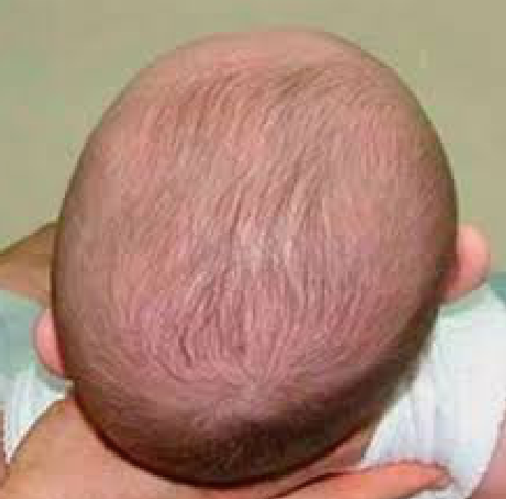 plagiocéphalie du bébé