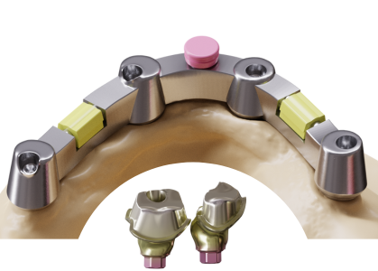 Revolutionising Custom Abutments and Implant Bars