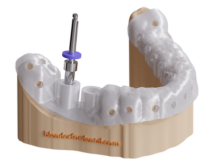 Implant guides with style!