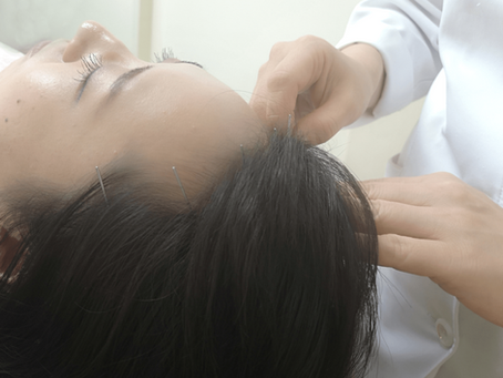 髪の薄毛に頭皮への鍼施術を試してみませんか