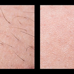 Depilation and sugaring. Hair removal. follicle. Woman leg with sugar or wax. Before and a