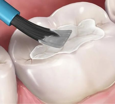 Composite Restorations in Pediatric Dentistry: Clinical Techniques, Applications & Material Selection