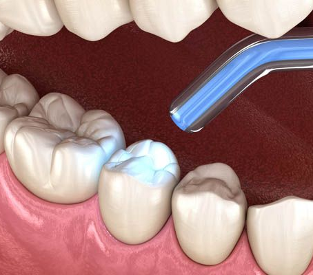 Dental Composite Classification in Pediatric Dentistry: Types, Curing Methods and Clinical Applications